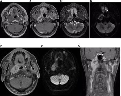 Epithelial–myoepithelial carcinoma of the nasopharynx: A case report and review of the literature